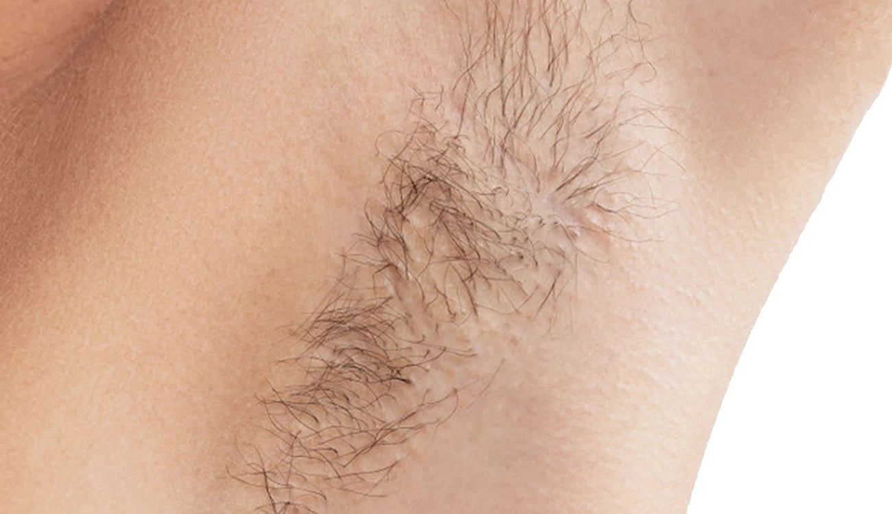 Visible Hair Removal Results